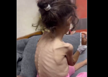 Börn í Gaza fá aðeins 245 kaloríur á dag